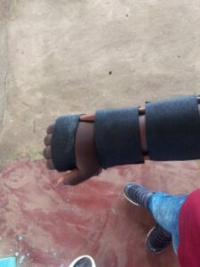 A hand splint can be used to support and protect the hand and wrist in individuals with brachial plexus injuries. The brachial plexus is a network of nerves that originates in the spinal cord and controls movement and sensation in the arm, forearm, and hand.

A hand splint can help in several ways:

1. *Prevents contractures*: By maintaining proper alignment and positioning of the hand and wrist, a splint can help prevent contractures (permanent shortening of muscles or tendons).
2. *Reduces pain*: Immobilizing the hand and wrist can help reduce pain and discomfort associated with brachial plexus injuries.
3. *Supports weak or paralyzed muscles*: A splint can provide support and stability, enabling individuals to perform daily activities with more ease.
4. *Improves function*: By maintaining proper hand and wrist positioning, a splint can help improve hand function and dexterity.
5. *Enhances safety*: A splint can protect the hand from injury or further damage.

A hand splint for brachial plexus injuries is typically custom-made by an occupational therapist or orthotist to meet the individual's specific needs.
#ARCH Dibanda
#Diocese of Buea